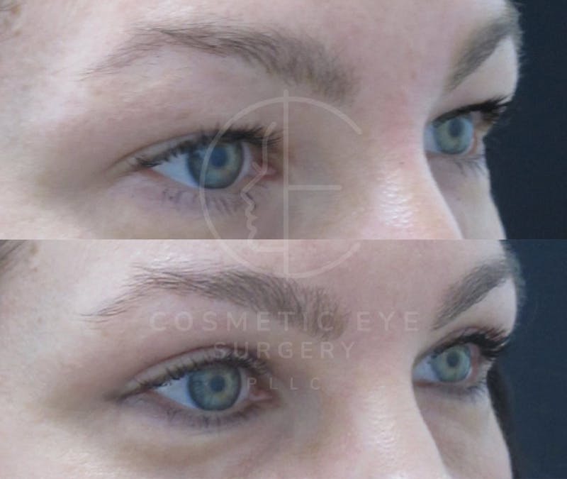 Cosmetic Eye Gallery Before & After Gallery - Patient 655155 - Image 2
