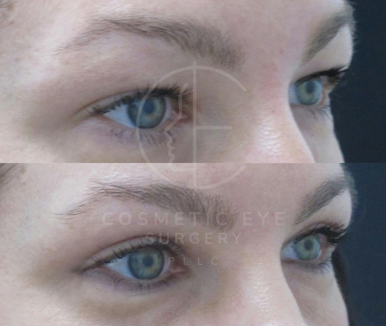 Upper Eyelid Blepharoplasty Patient Image #2