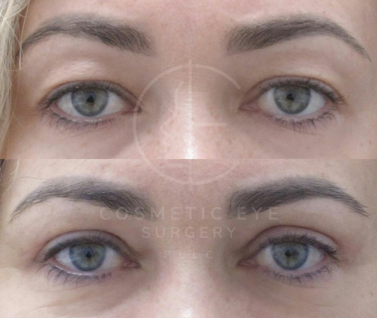 Upper Blepharoplasty in Young Patient Patient Image #1