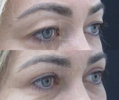 Cosmetic Eye Gallery Before & After Gallery - Patient 360027 - Image 2