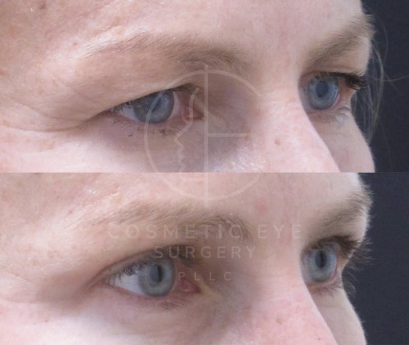 Cosmetic Eye Gallery Before & After Gallery - Patient 395944 - Image 2