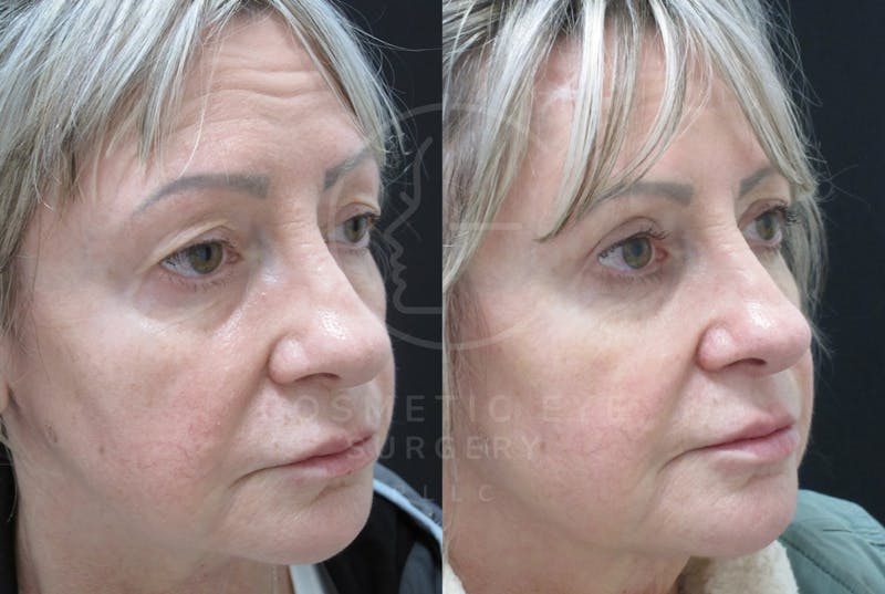 Cosmetic Eye Gallery Before & After Gallery - Patient 380756 - Image 2