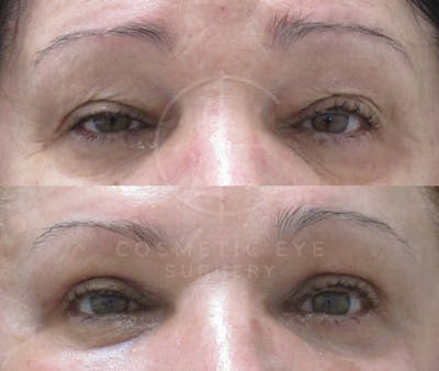 Cosmetic Eye Gallery Before & After Gallery - Patient 153295 - Image 1