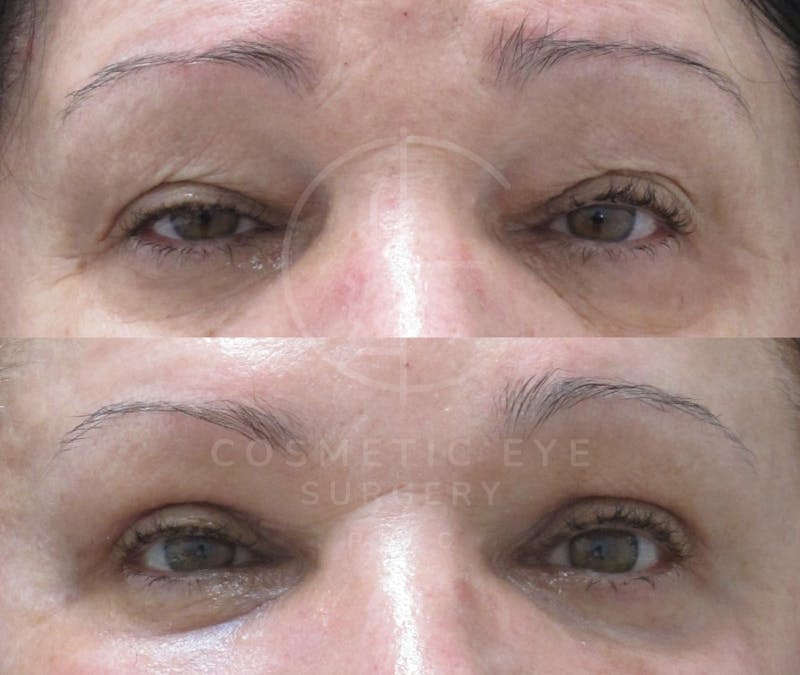 Cosmetic Eye Gallery Before & After Gallery - Patient 153295 - Image 1