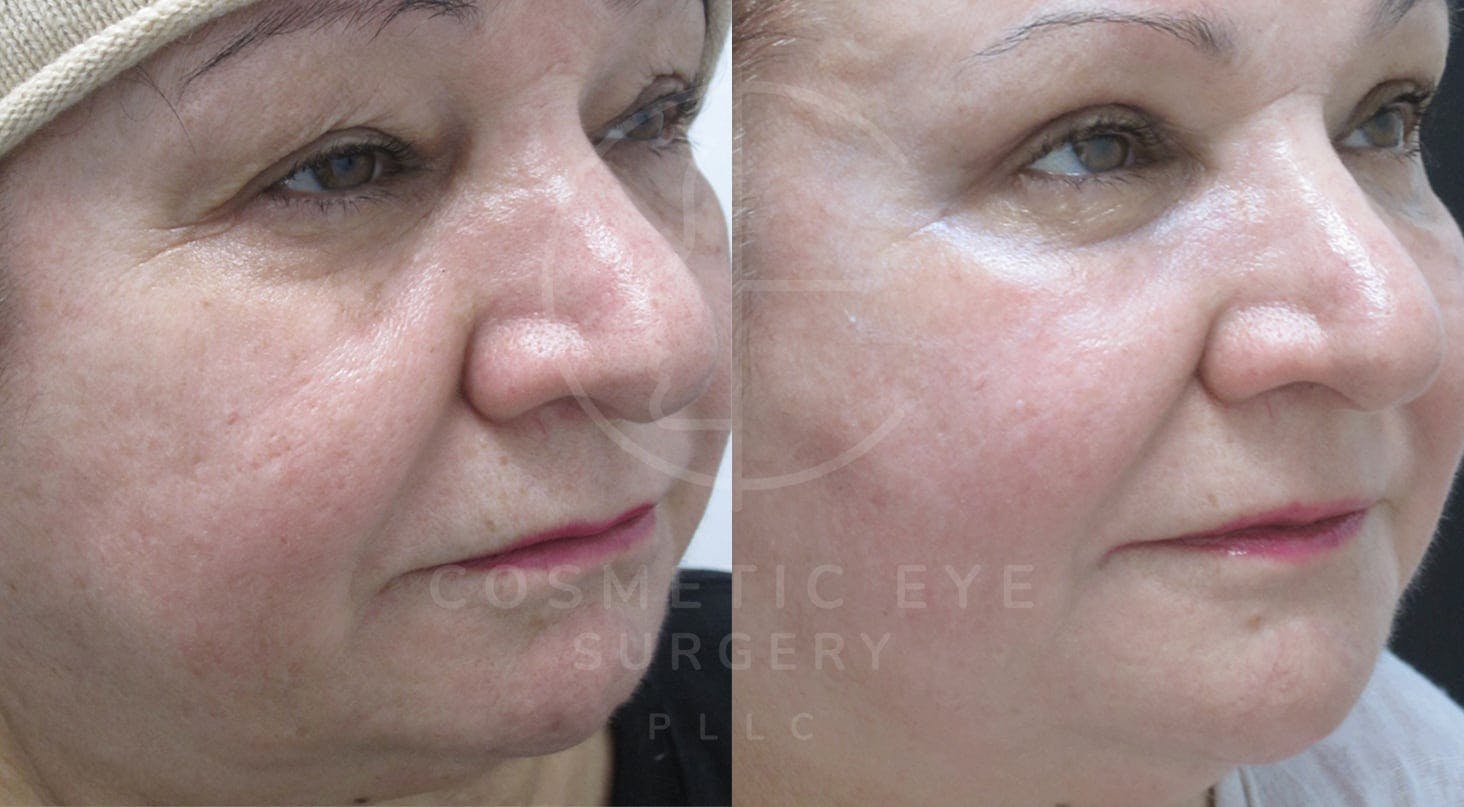 Upper Blepharoplasty & Full Face CO₂ LASER Patient Image #2