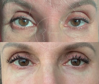 Cosmetic Eye Gallery Before & After Gallery - Patient 969675 - Image 1