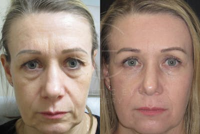 Cosmetic Eye Gallery Before & After Gallery - Patient 753837 - Image 2