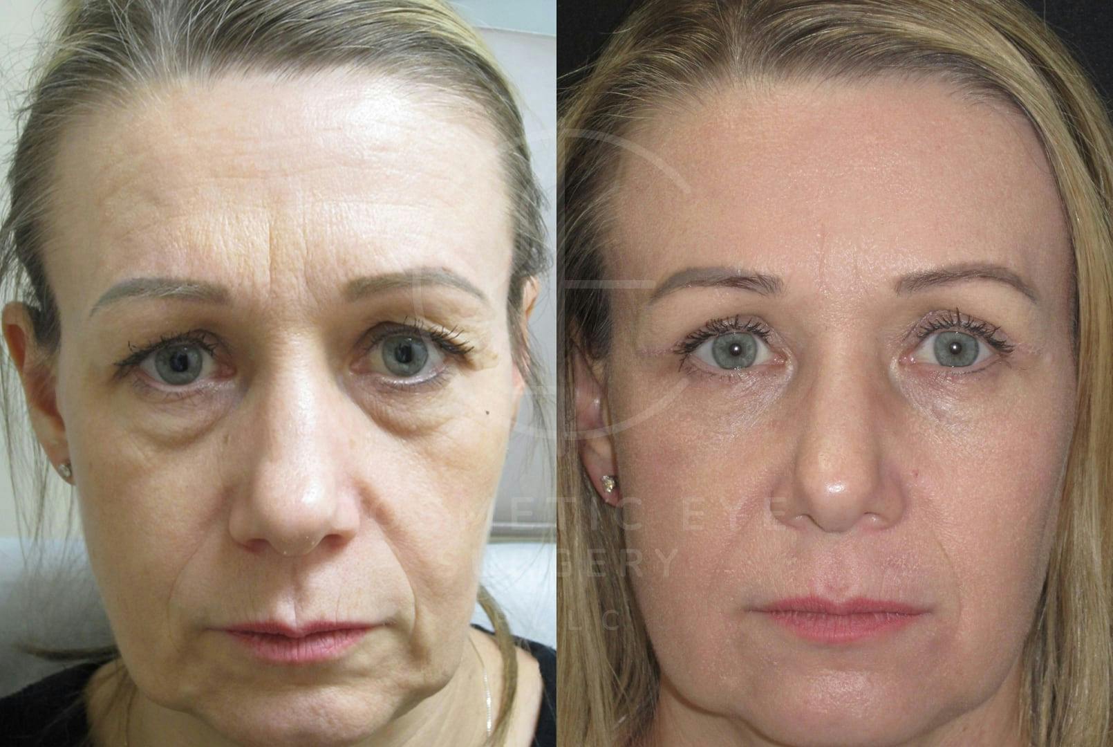Quad Blepharoplasty & CO₂ LASER Patient Image #2