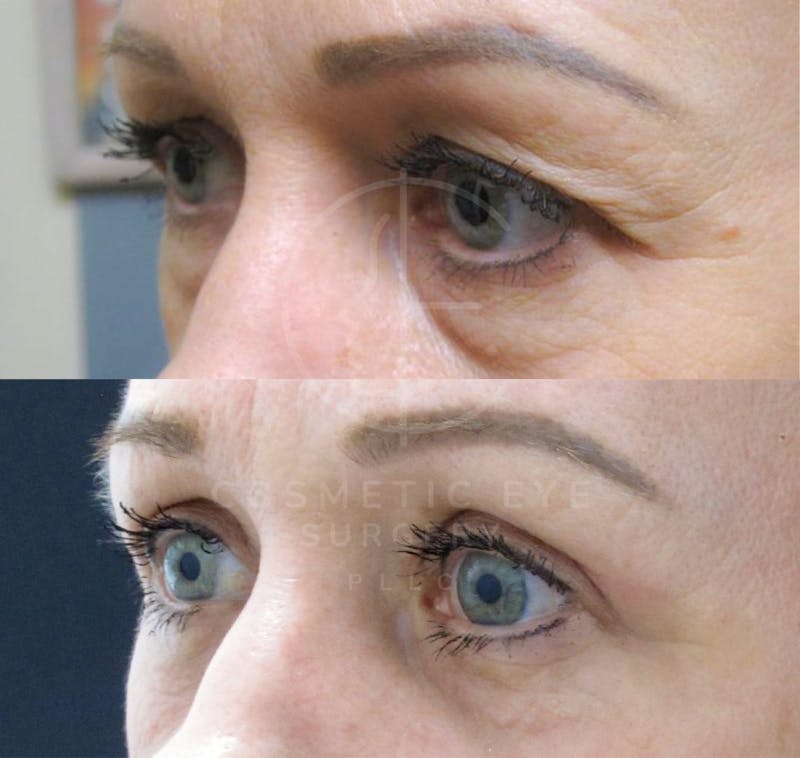 Cosmetic Eye Gallery Before & After Gallery - Patient 753837 - Image 1