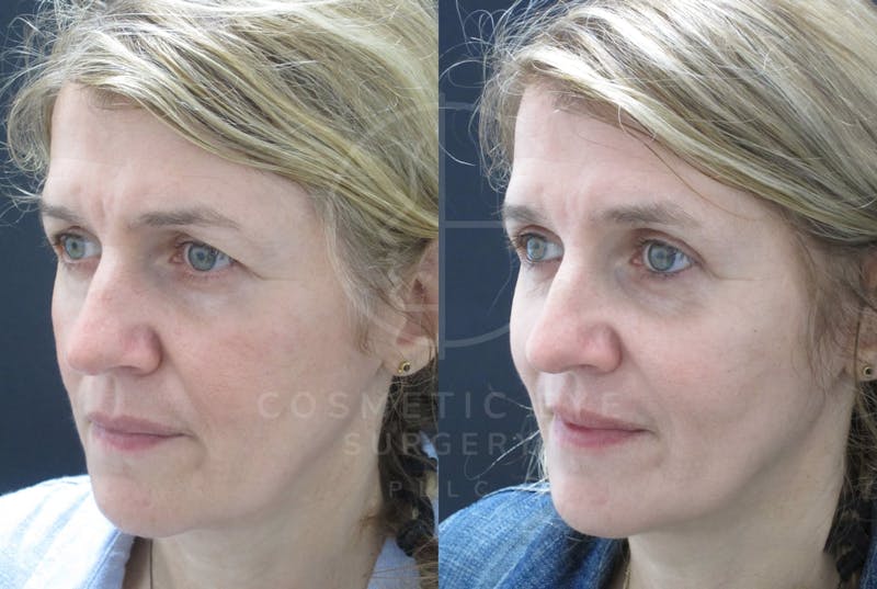 Cosmetic Eye Gallery Before & After Gallery - Patient 315031 - Image 1