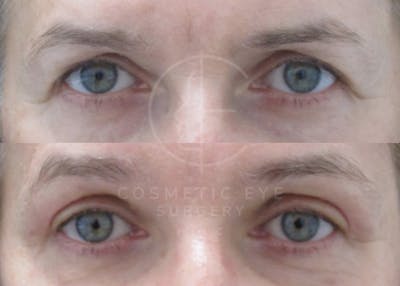 Cosmetic Eye Gallery Before & After Gallery - Patient 315031 - Image 2