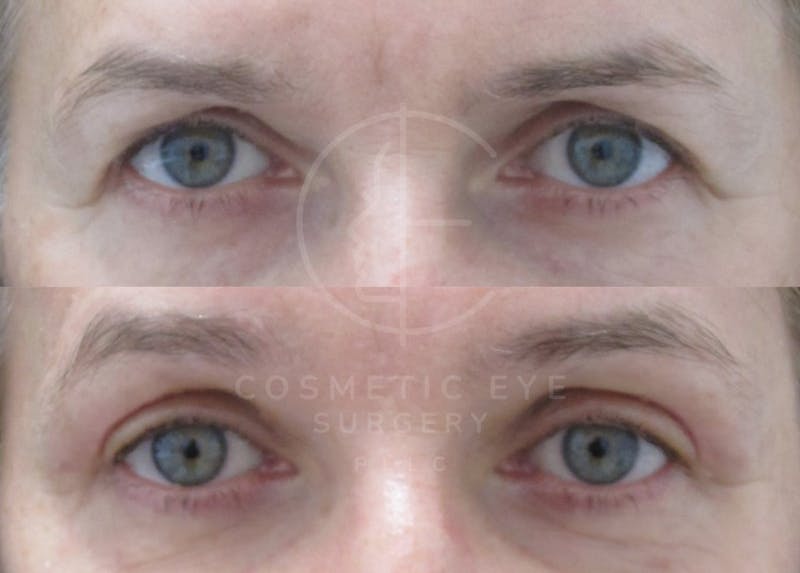 Cosmetic Eye Gallery Before & After Gallery - Patient 315031 - Image 2