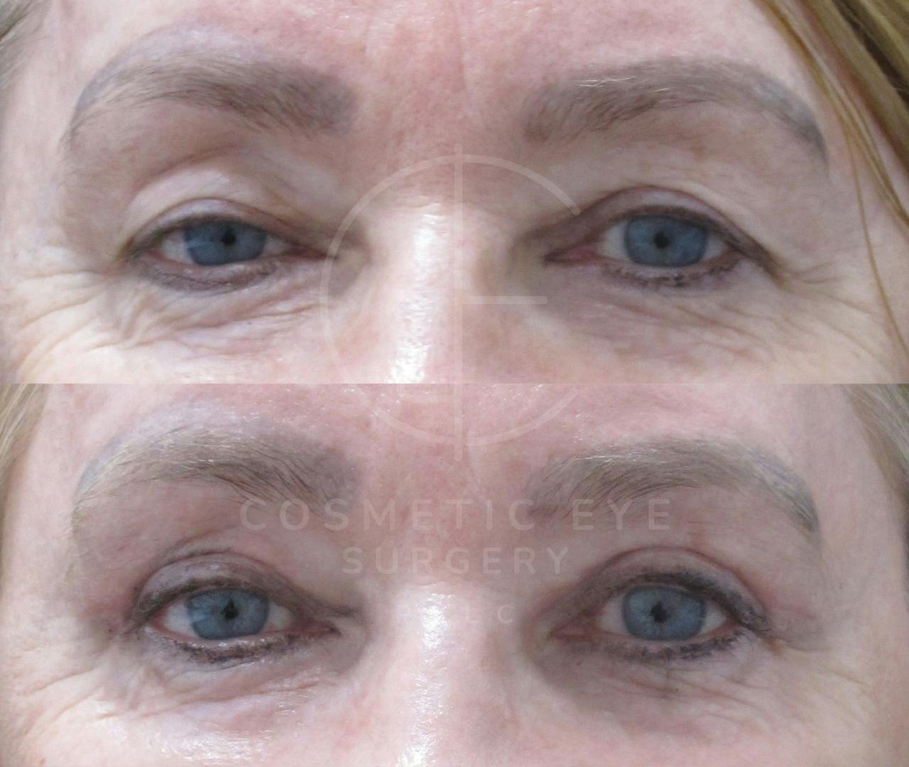Upper Eyelid Blepharoplasty Patient Image #3