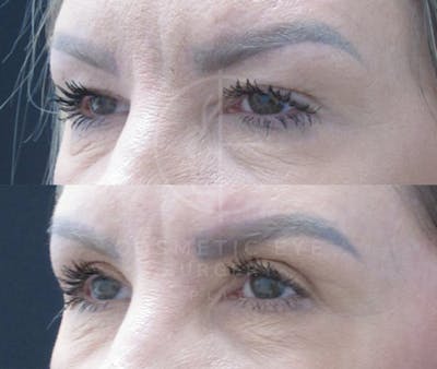 Cosmetic Eye Gallery Before & After Gallery - Patient 127332 - Image 1