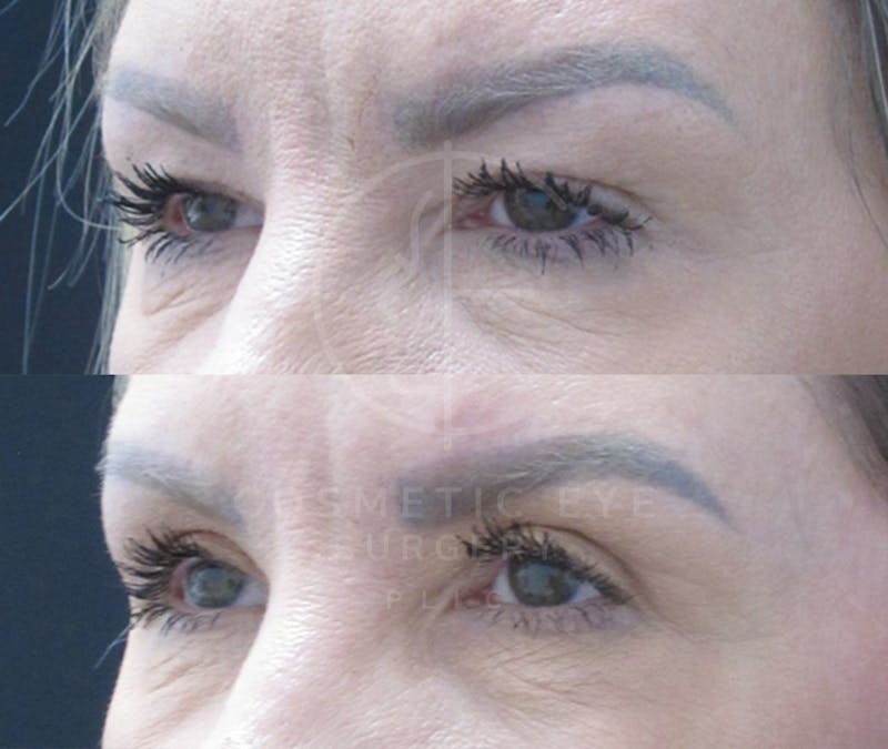 Cosmetic Eye Gallery Before & After Gallery - Patient 127332 - Image 1