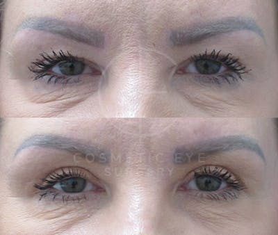 Cosmetic Eye Gallery Before & After Gallery - Patient 127332 - Image 2