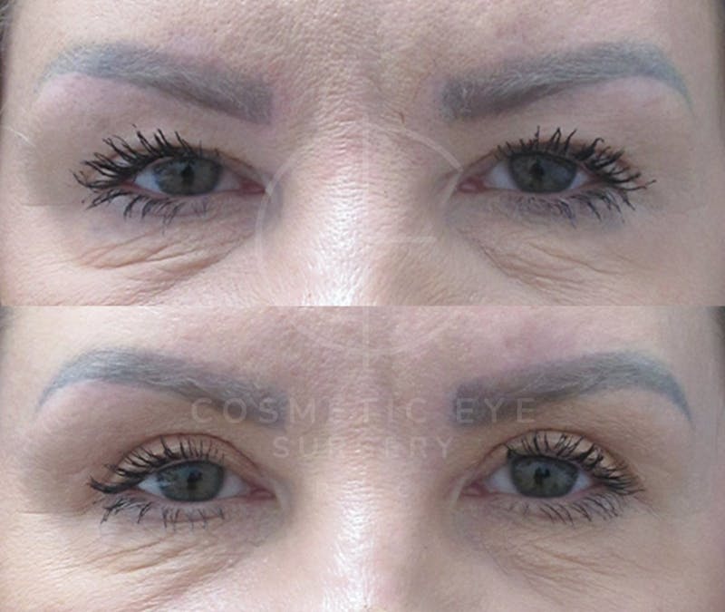 Cosmetic Eye Gallery Before & After Gallery - Patient 127332 - Image 2