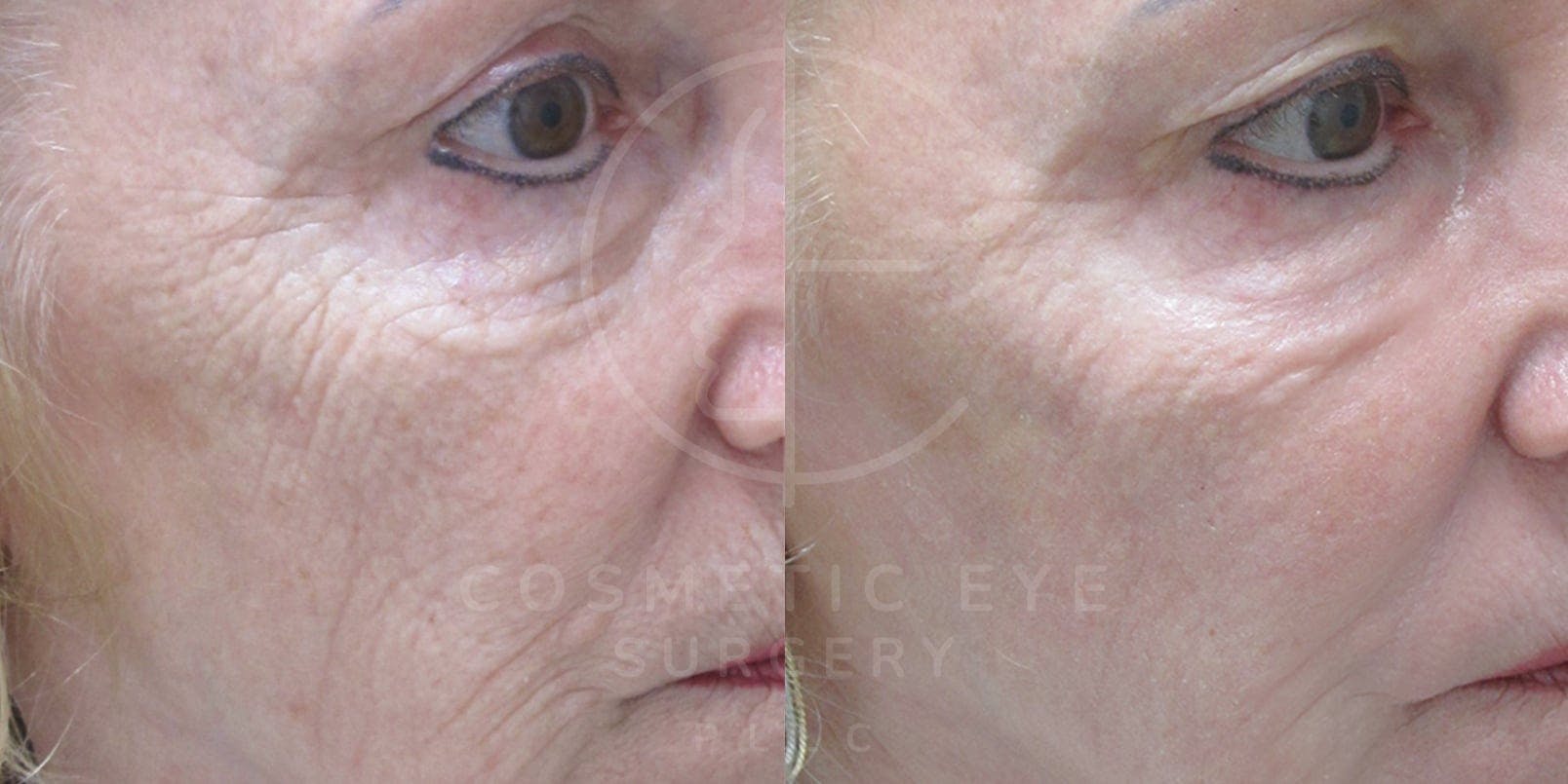 CO₂ LASER Skin Resurfacing Patient Image #1