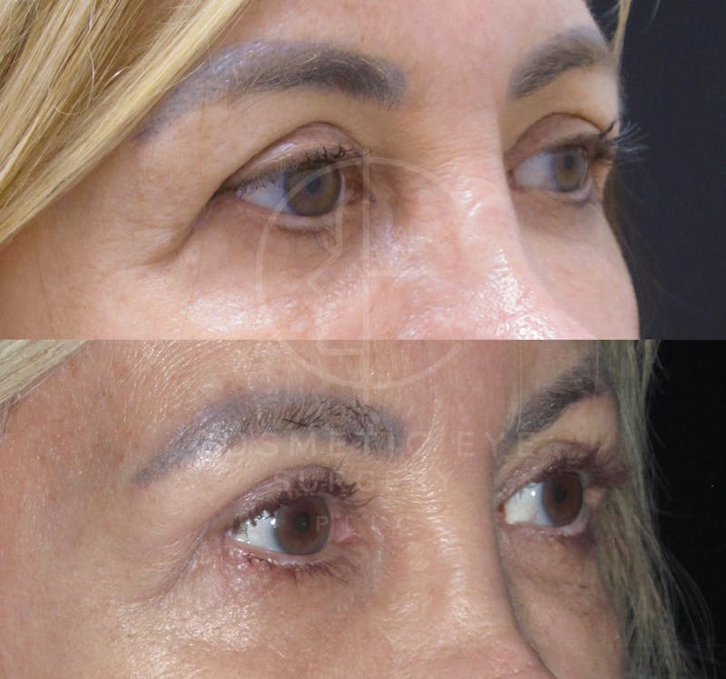 Cosmetic Eye Gallery Before & After Gallery - Patient 150926 - Image 1