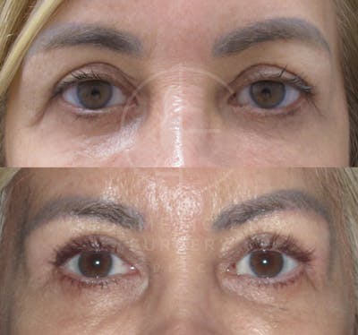 Cosmetic Eye Gallery Before & After Gallery - Patient 150926 - Image 2