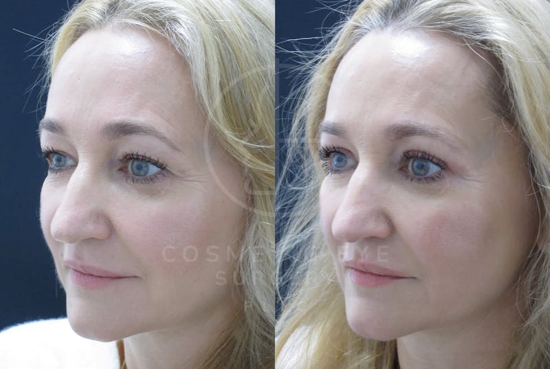 Cosmetic Eye Gallery Before & After Gallery - Patient 176167 - Image 1