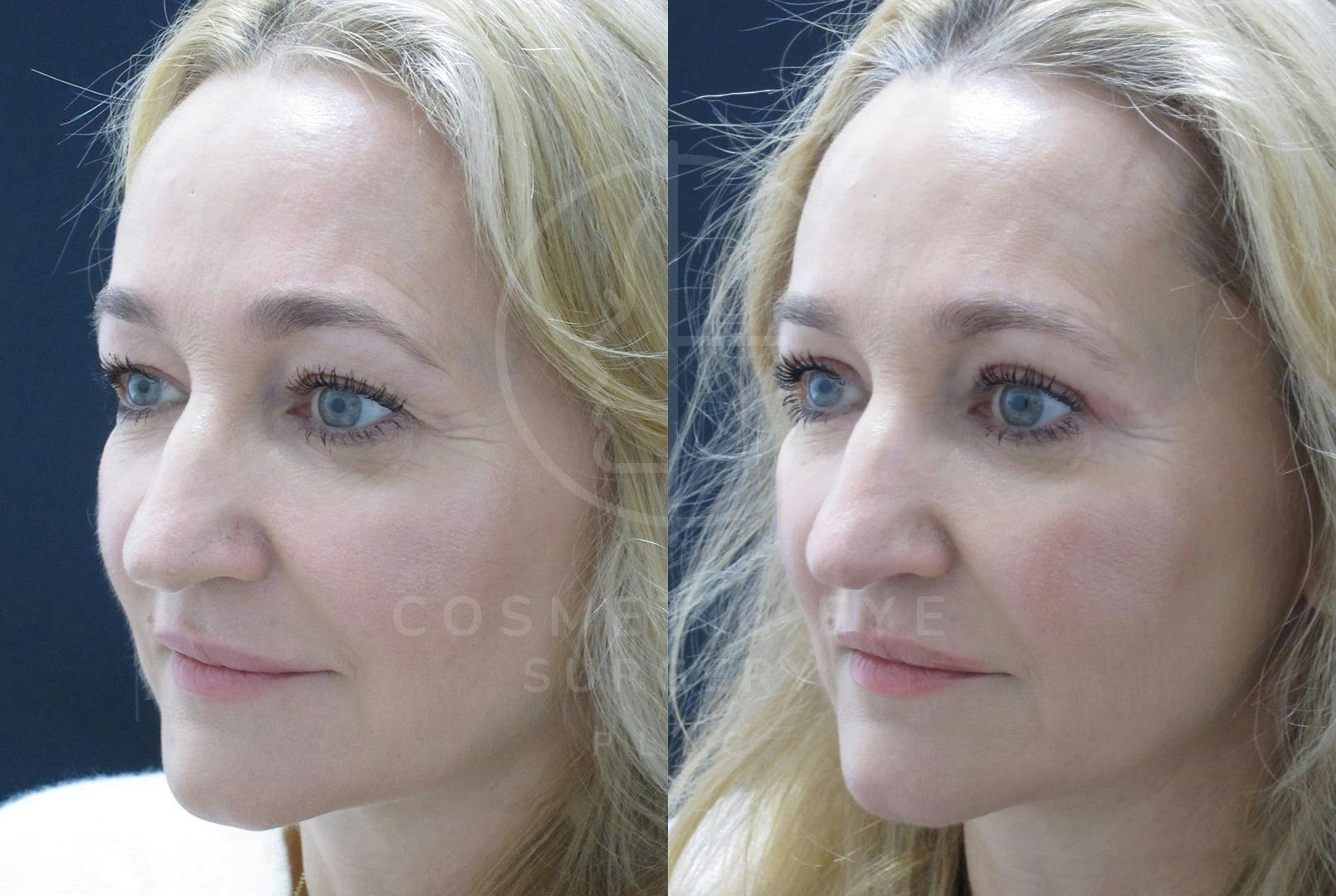 Upper Blepharoplasty Patient Image #1