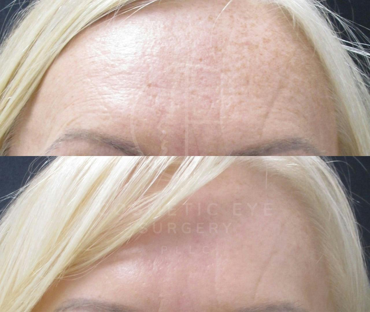 CO₂ Resurfacing for Sun damage Patient Image #1
