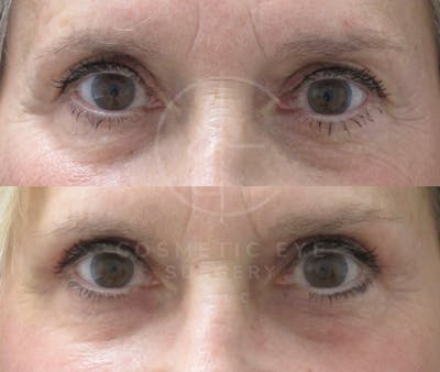 Cosmetic Eye Gallery Before & After Gallery - Patient 397475 - Image 2