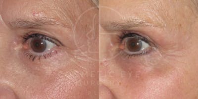 Cosmetic Eye Gallery Before & After Gallery - Patient 397475 - Image 1