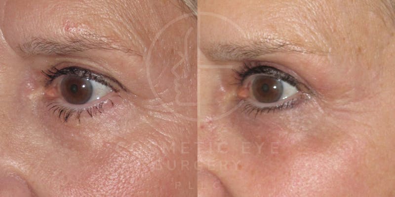 Cosmetic Eye Gallery Before & After Gallery - Patient 397475 - Image 1