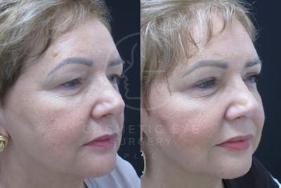 Cosmetic Eye Gallery Before & After Gallery - Patient 146404 - Image 1