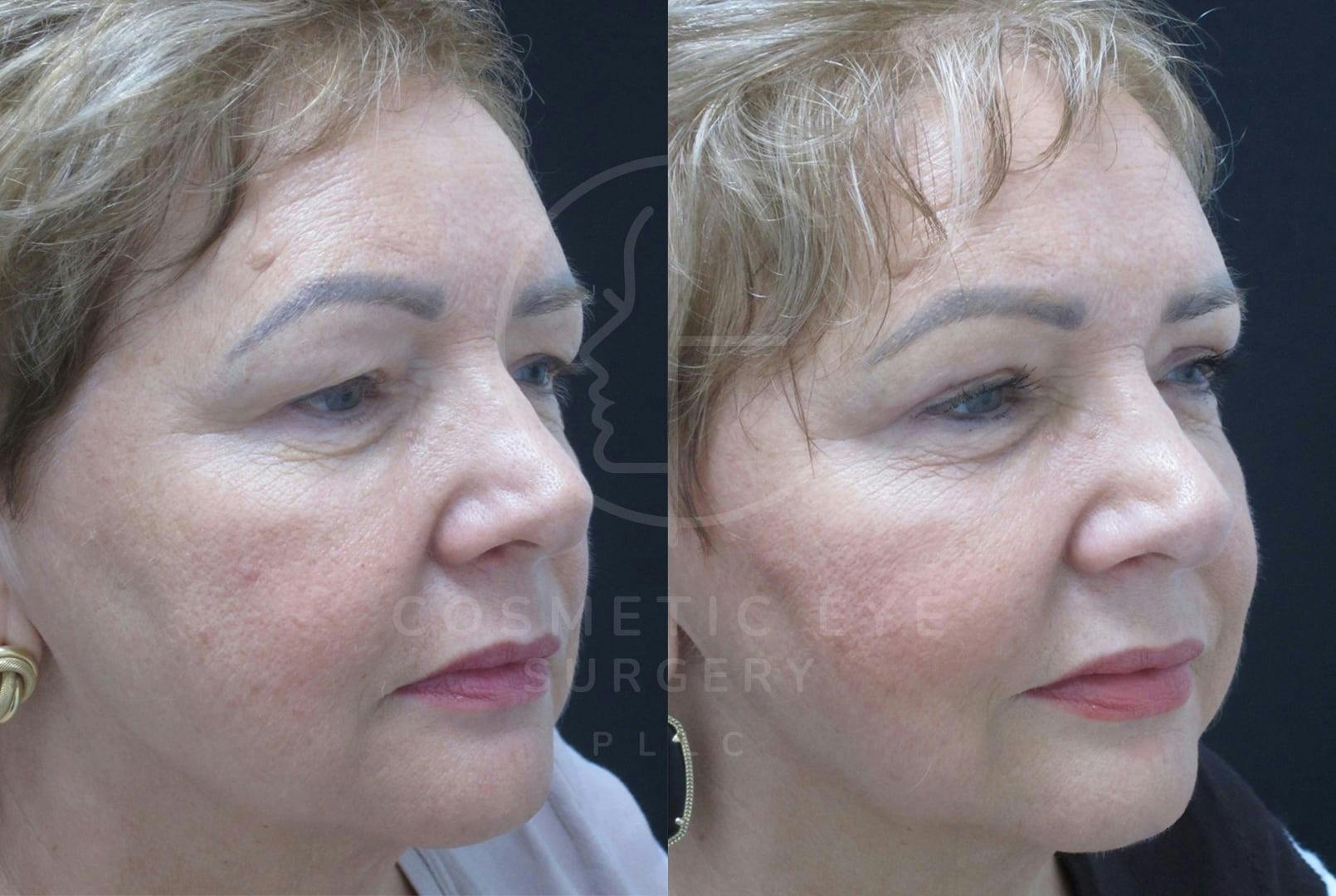 Upper Eyelid Blepharoplasty Patient Image #1