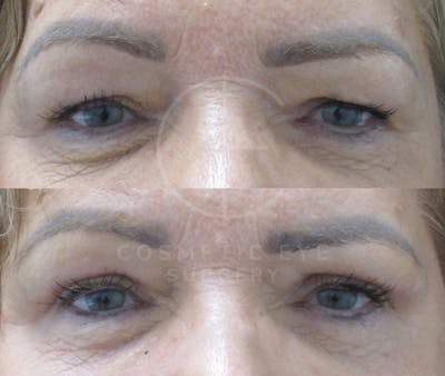 Cosmetic Eye Gallery Before & After Gallery - Patient 146404 - Image 2