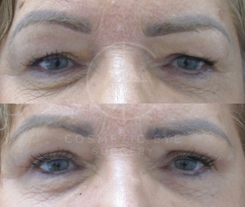 Cosmetic Eye Gallery Before & After Gallery - Patient 146404 - Image 2