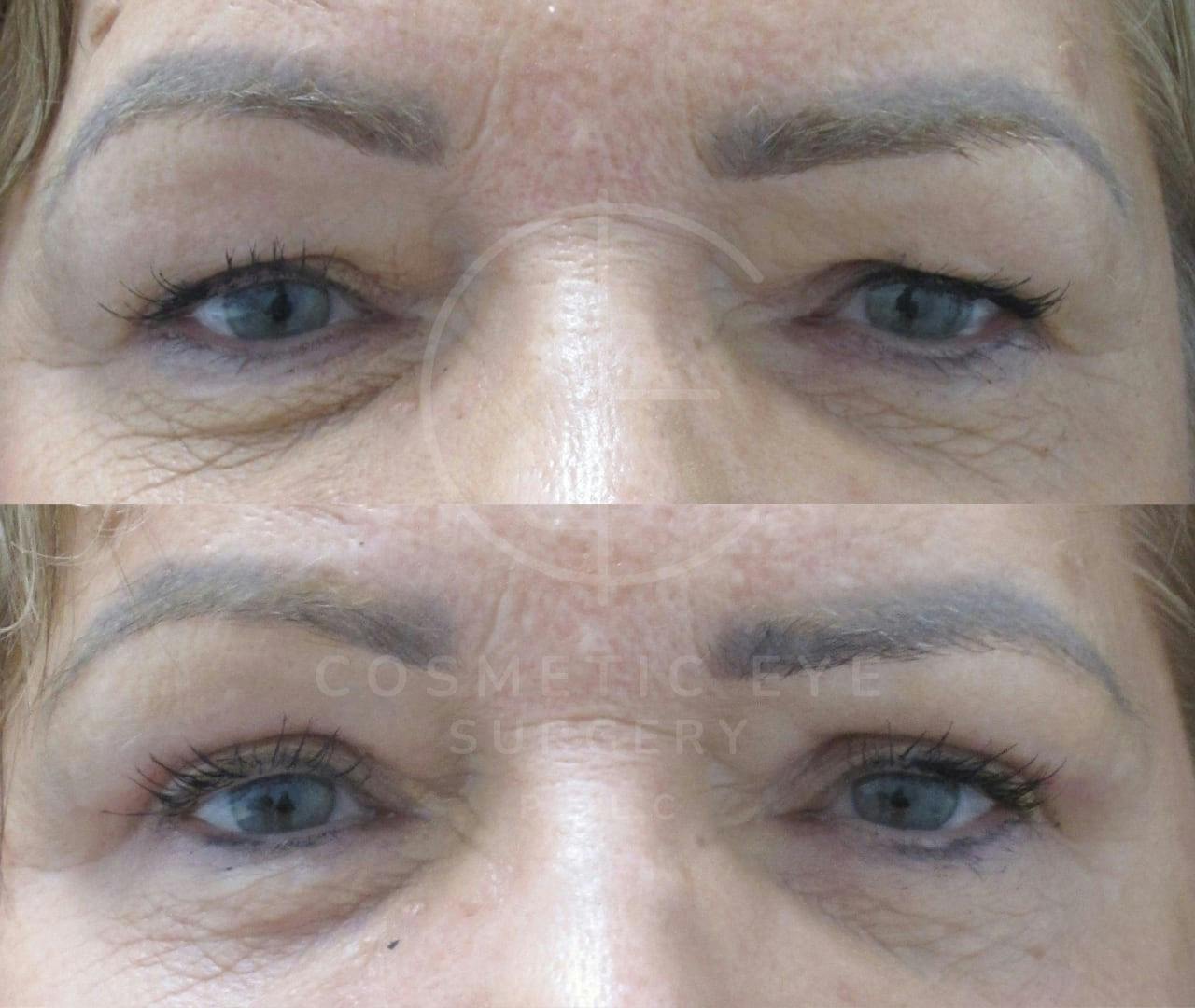 Upper Eyelid Blepharoplasty Patient Image #2