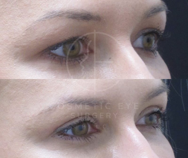 Cosmetic Eye Gallery Before & After Gallery - Patient 993527 - Image 4