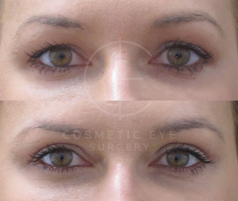Cosmetic Eye Gallery Before & After Gallery - Patient 993527 - Image 5