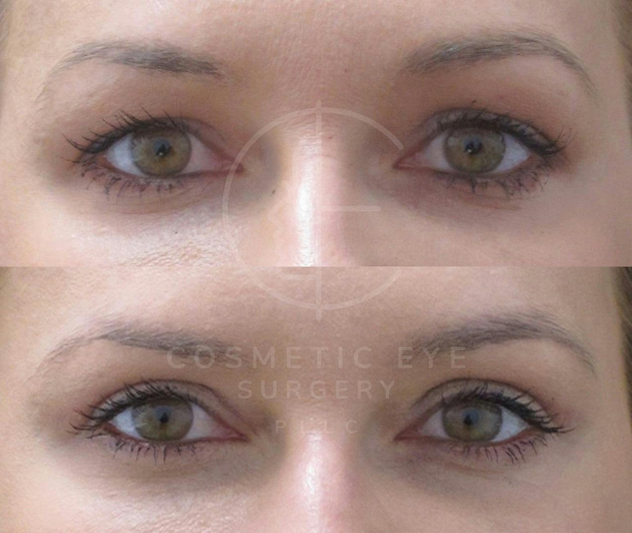 Upper Eyelid Blepharoplasty Patient Image #5