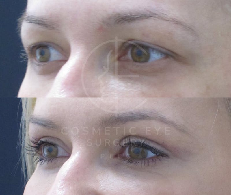 Cosmetic Eye Gallery Before & After Gallery - Patient 993527 - Image 3