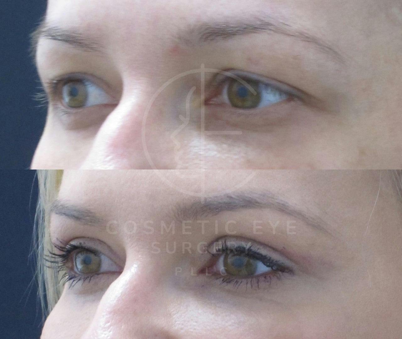 Upper Eyelid Blepharoplasty Patient Image #3