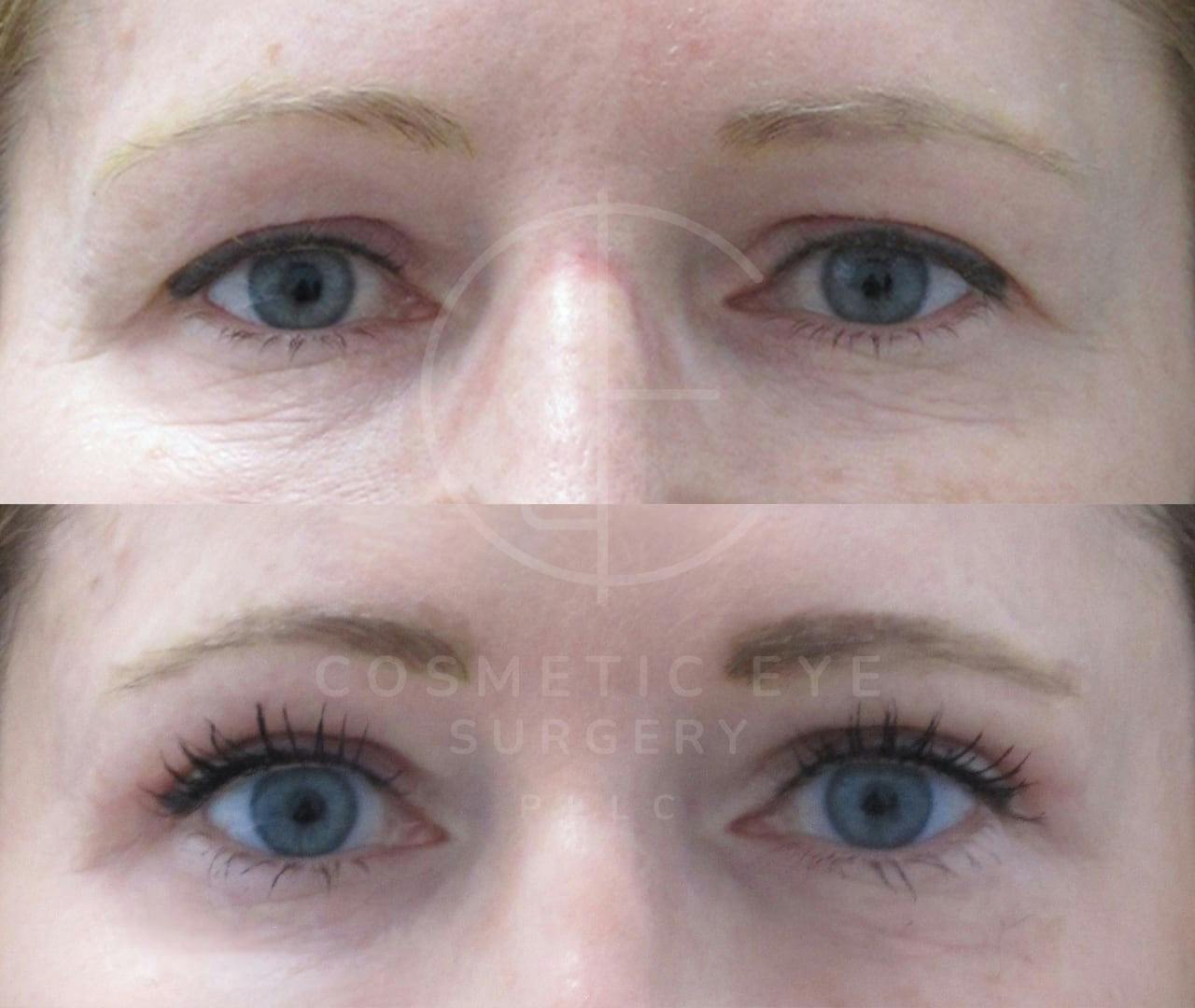 Upper Eyelid Surgery & Full Face CO₂ LASER resurfacing Patient Image #3
