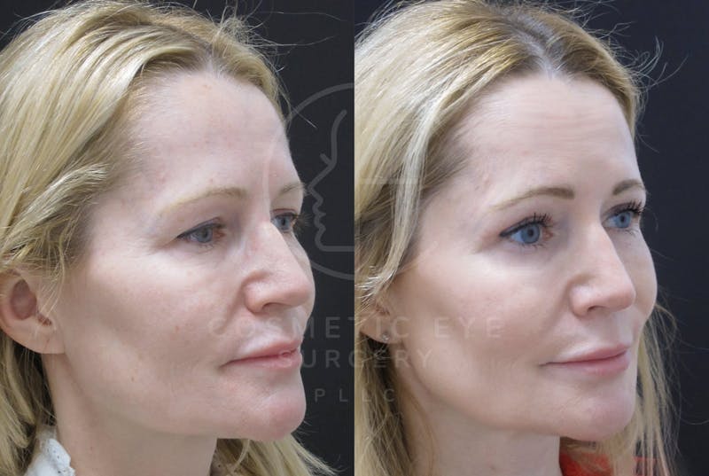 Cosmetic Eye Gallery Before & After Gallery - Patient 366734 - Image 4