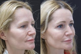 Cosmetic Eye Gallery Before & After Gallery - Patient 366734 - Image 4