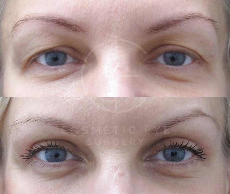 Cosmetic Eye Gallery Before & After Gallery - Patient 604212 - Image 3