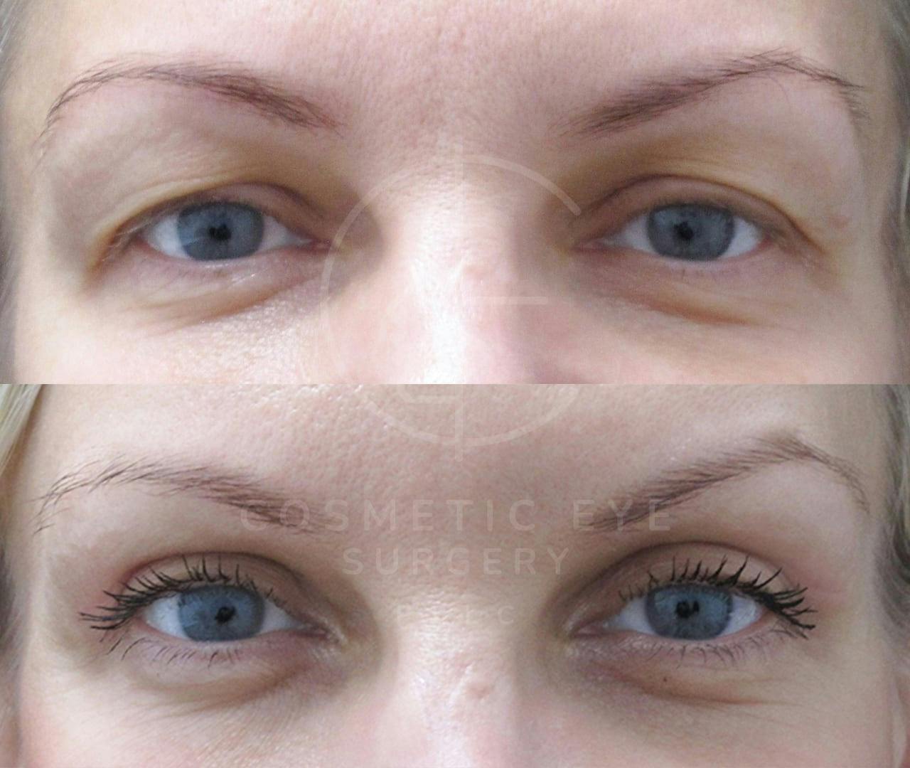 Upper Eyelid Blepharoplasty Patient Image #3
