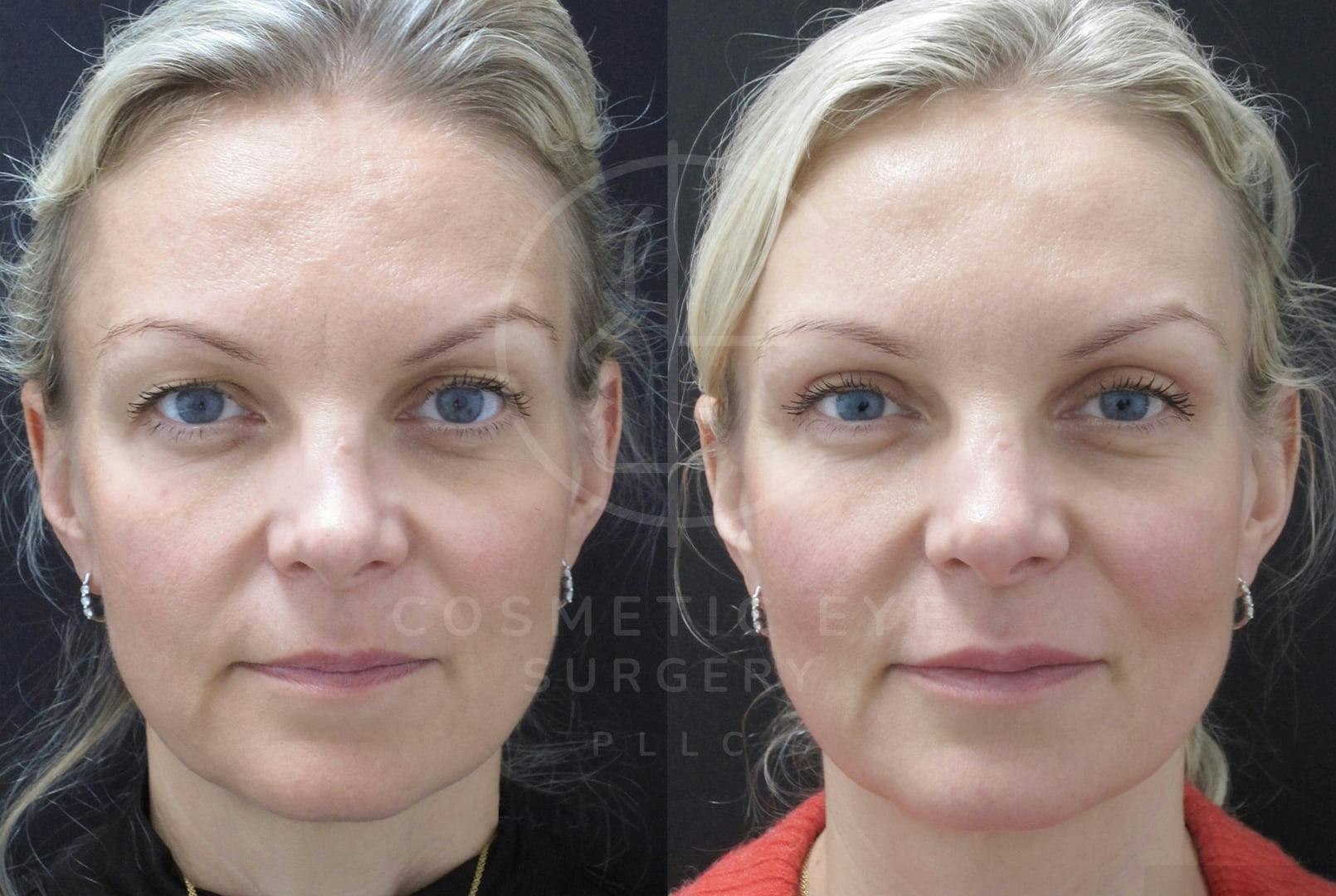 Upper Eyelid Blepharoplasty Patient Image #2