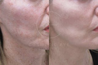 Cosmetic Eye Gallery Before & After Gallery - Patient 199102 - Image 4