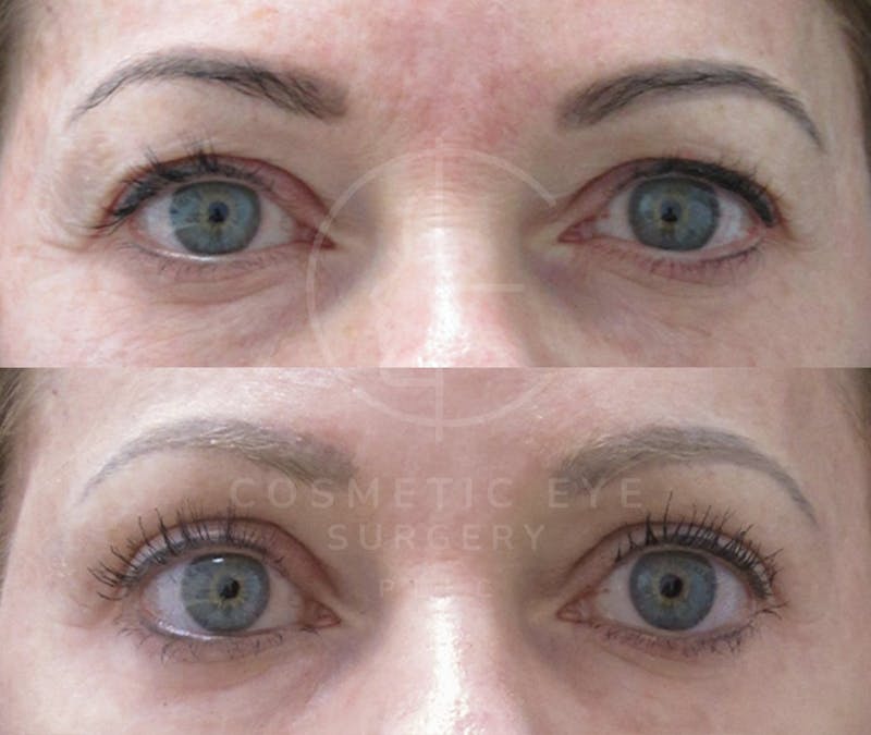Cosmetic Eye Gallery Before & After Gallery - Patient 199102 - Image 3