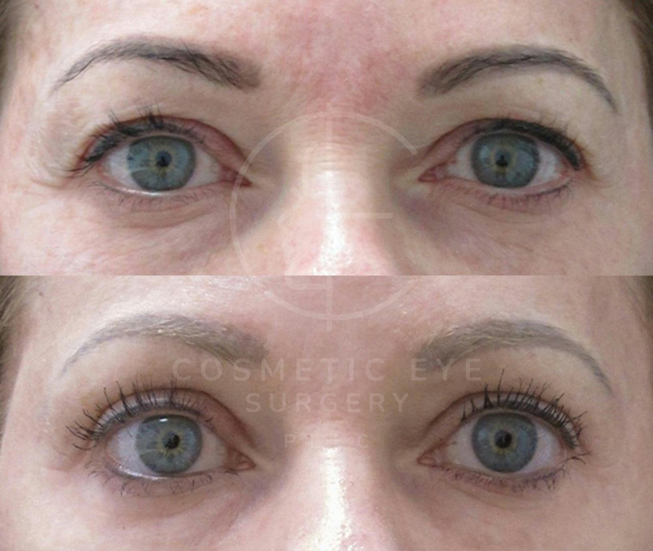 Upper Eyelid Blepharoplasty & Full Face CO₂ LASER Patient Image #3