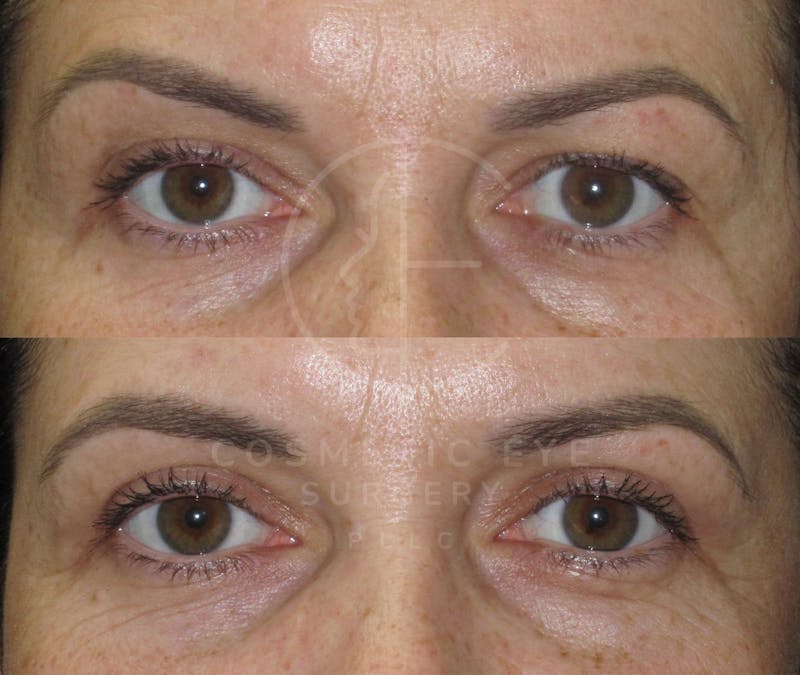 Cosmetic Eye Gallery Before & After Gallery - Patient 313945 - Image 3